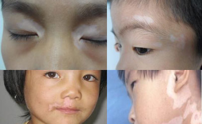孩子白斑是因什么因素病发的呢