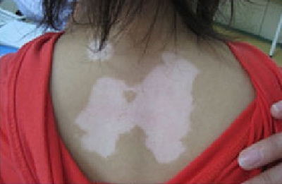 女性皮肤出现白斑是哪些因素引起