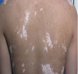 背部白斑有哪些症状表现