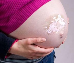 如何做好孕妇白癜风的护理