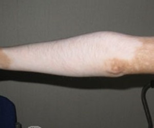 手臂出现白斑原因有哪些